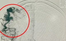 Phối hợp 5 chuyên khoa cứu sống bệnh nhân dị dạng mạch não